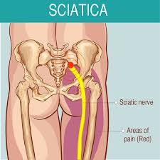 Sciatica Image