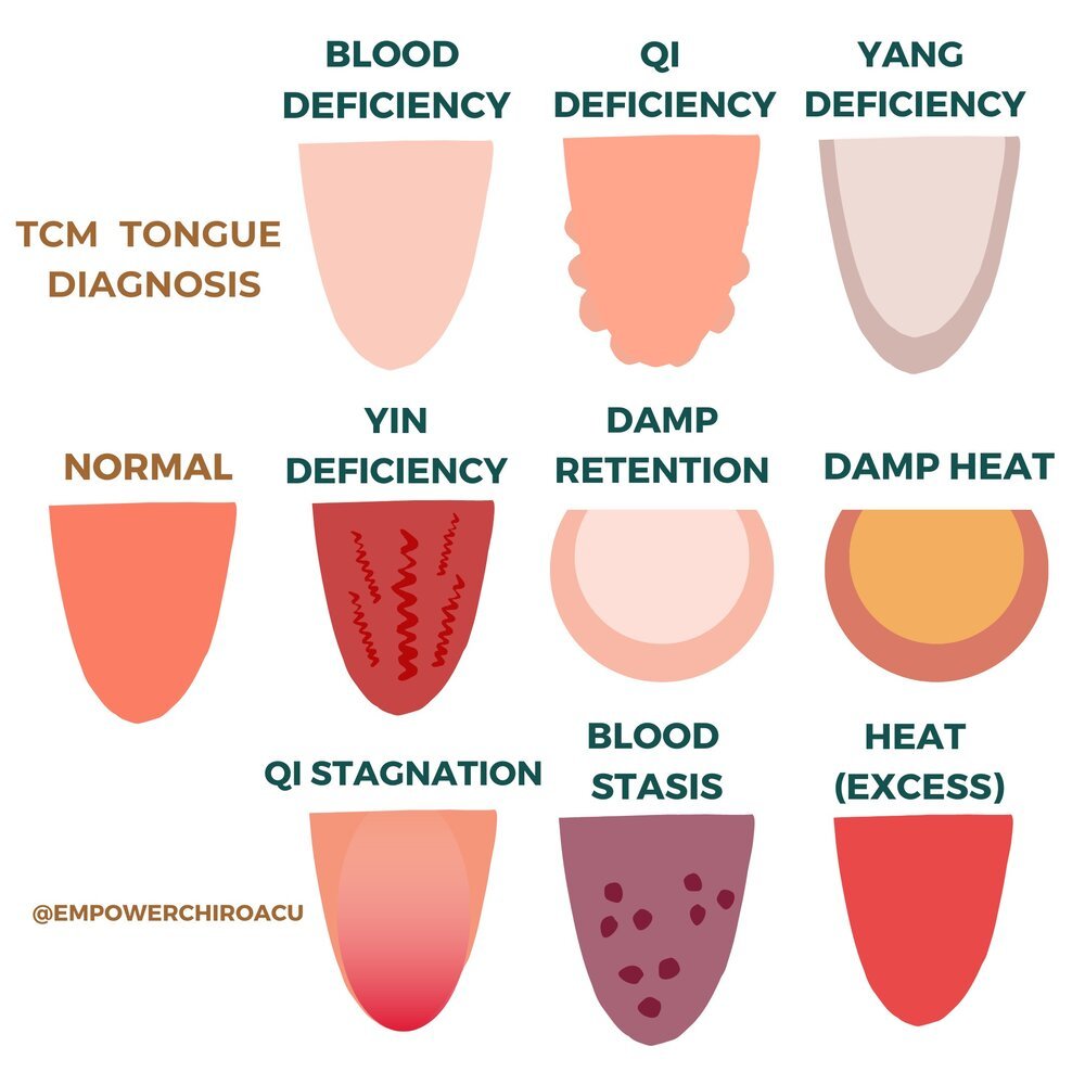 Tongue Diagnosis in Chinese Medicine | Acupuncture | Broadway Health  Collective