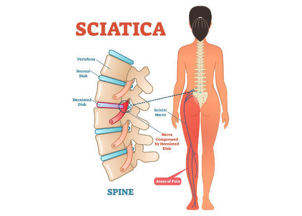 sciatica-low-back