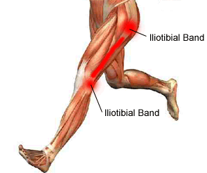 IT band syndrome diagram