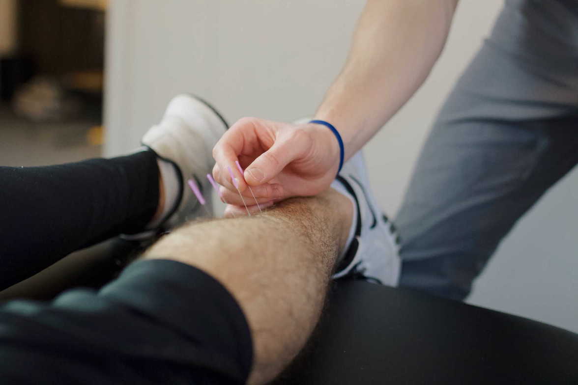  benefits Sports dry needling