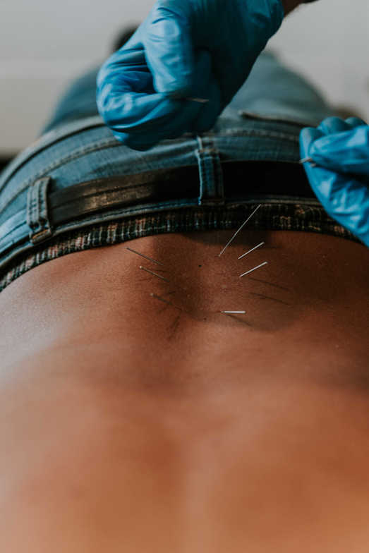 dry needling sun prairie low back pain physical therapy acupuncture dry needling pain relief