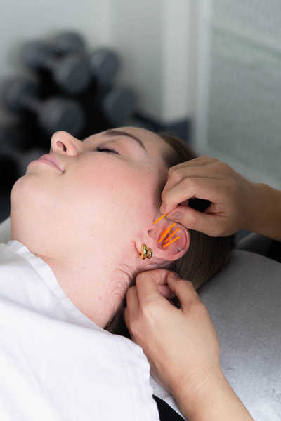 Auricular Acupuncture