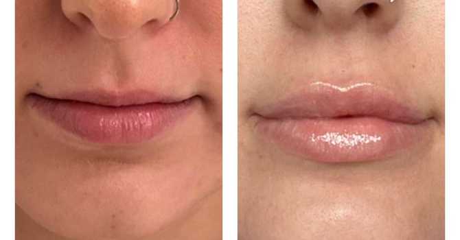 Dermal Lip Filler