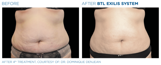 Before and after body contouring on abdomen