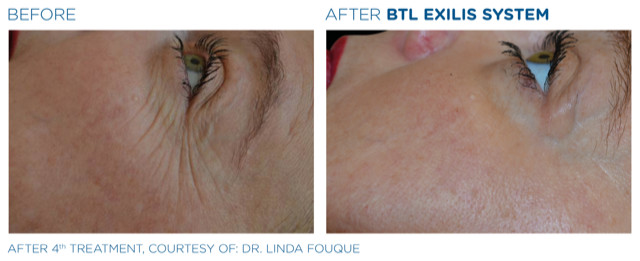 Before and After Body Contouring on Face 