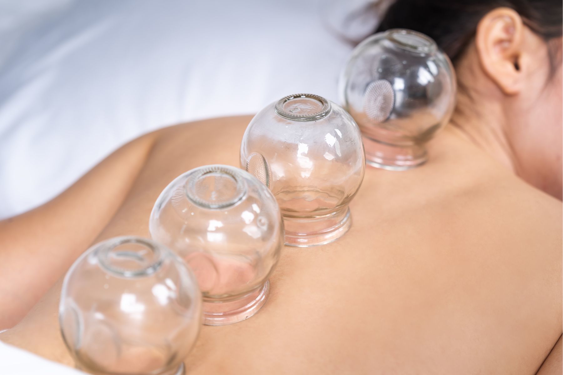 Cupping%20ahc%20wellness%20clinic