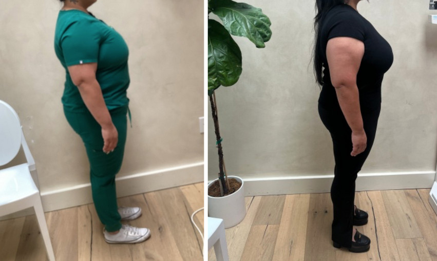 GLP-1 Weight loss before and after