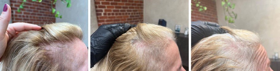 PRP Hair Before and After