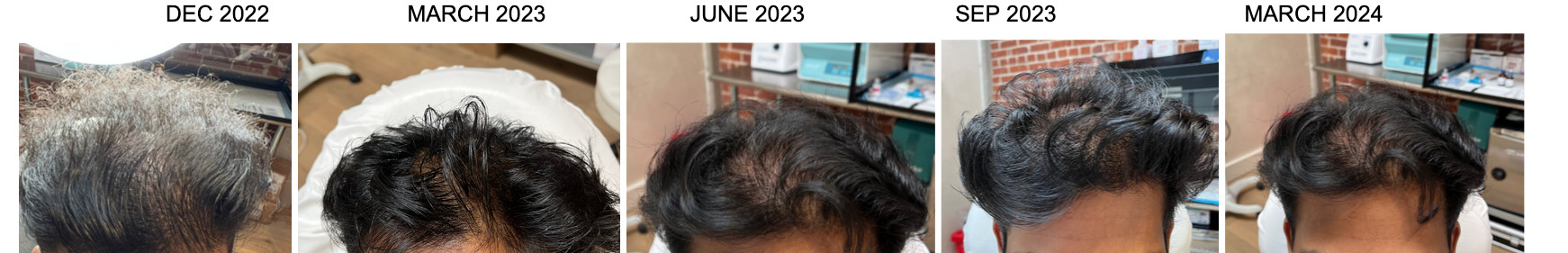 PRP Hair Before and After San Diego