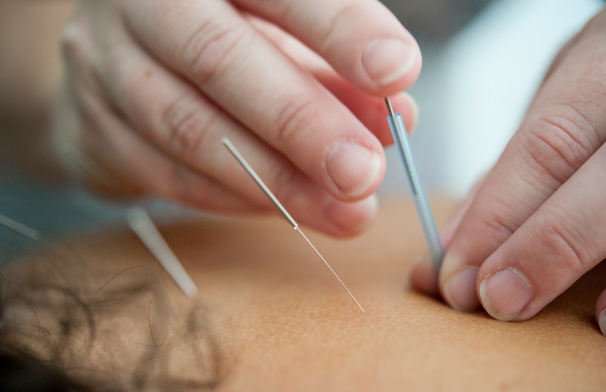 Licensed acupuncturist performing dry needling in Evanston clinic