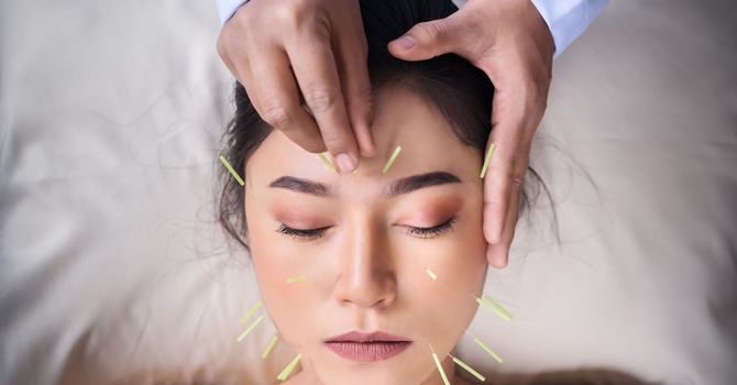What to Expect at Your First Acupuncture Appointment image