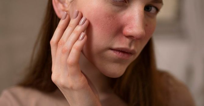 Rosacea & Redness