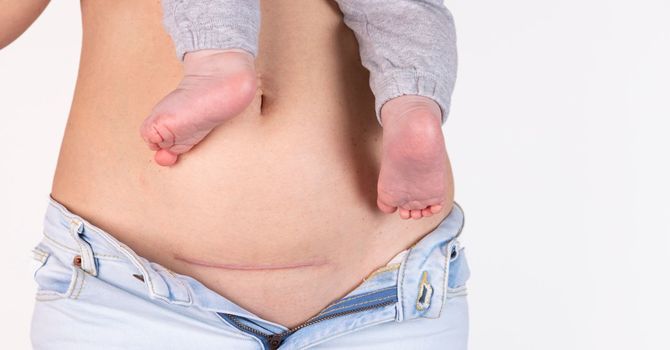C-Section Scars