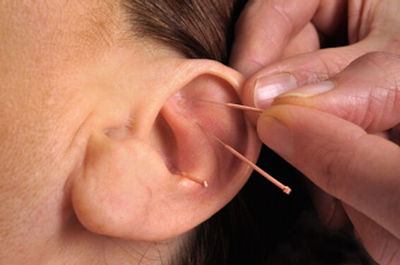 Link to: /pages/auricular-ear-acupuncture