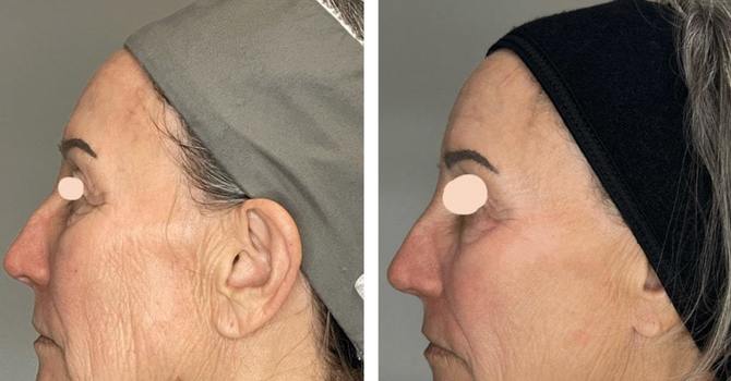 Why Fall is the Best Season for Laser Treatments image