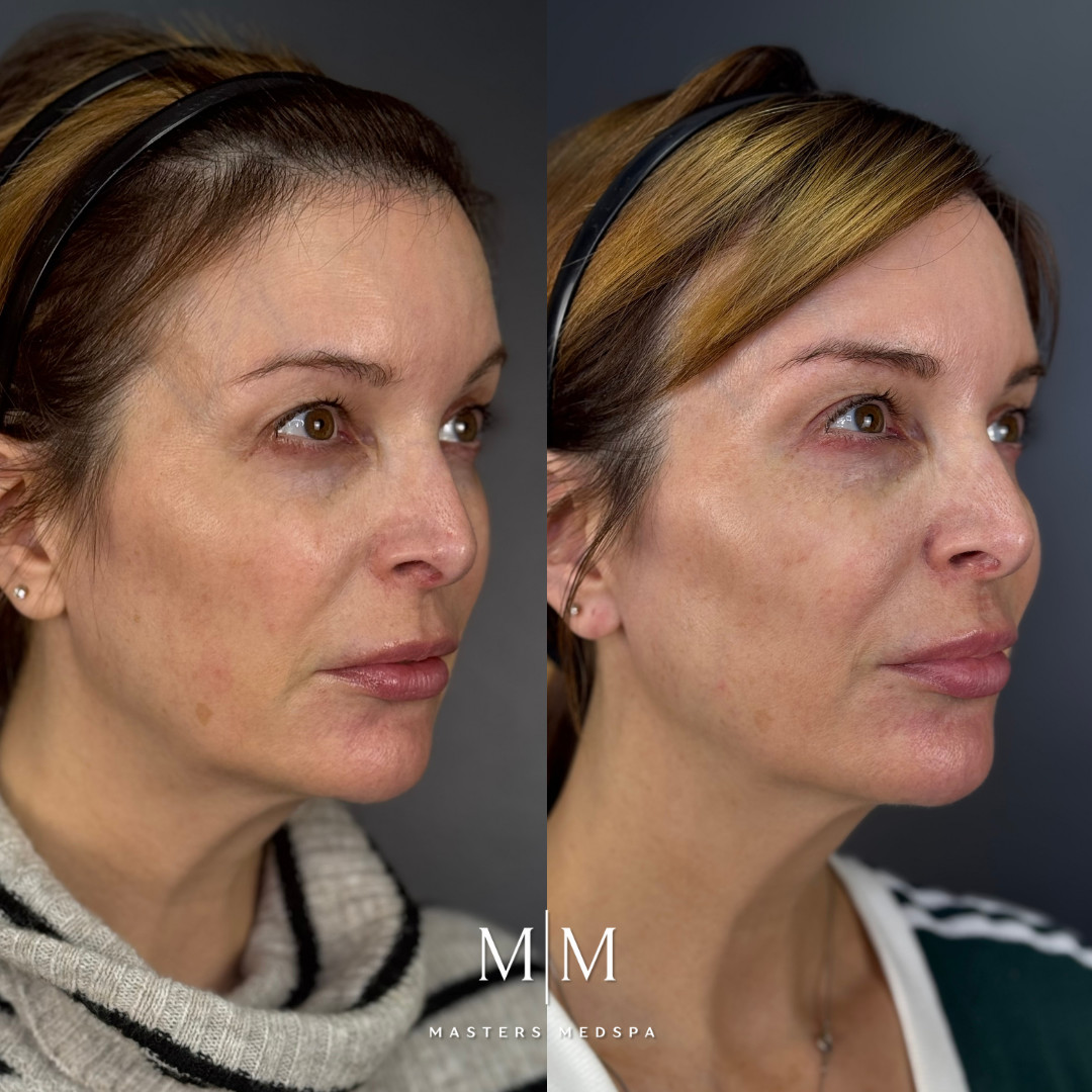 MM_B&A_UltraClear&Injectables_ByTannaz&Allison_1