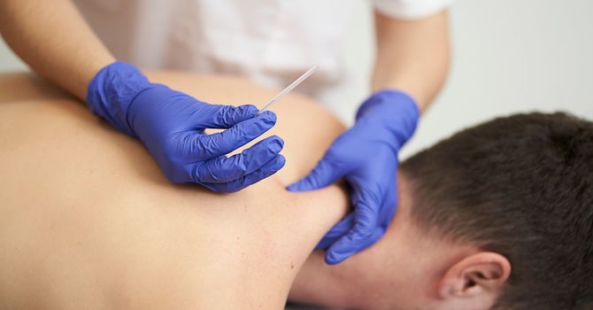 What Is Dry Needling? A Complete Guide from The Broad Street Practice in Stamford