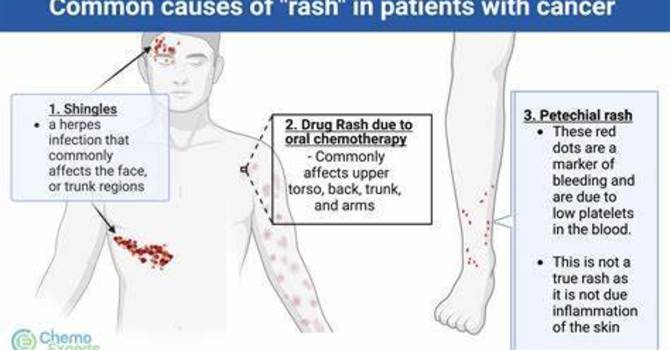 Rashes During Chemotherapy: What to Watch For and When to Act image