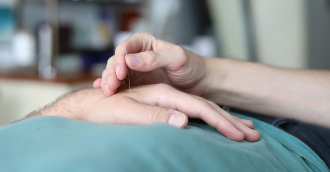Acupuncture