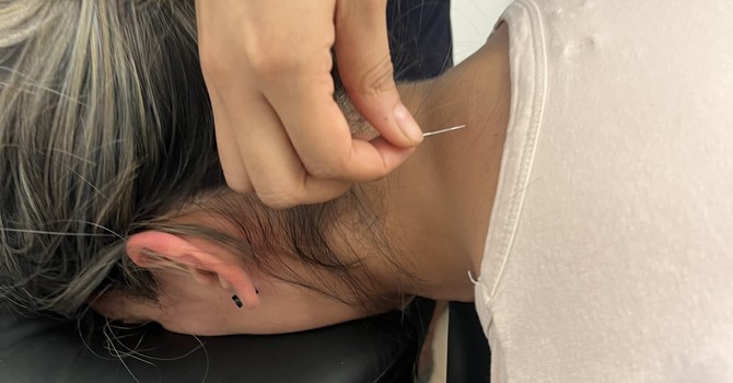 Medical Acupuncture vs. Dry Needling image