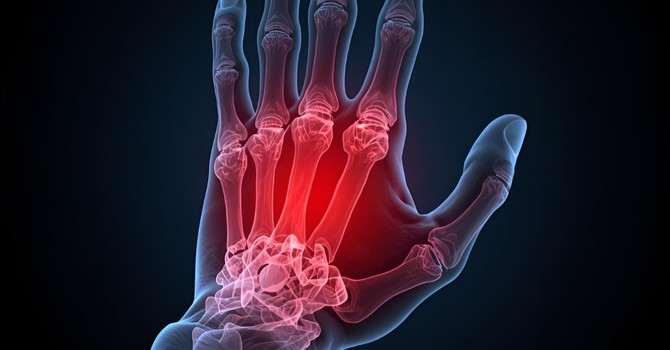 Arthritis Treatment
