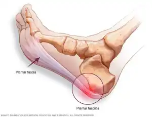 Medical illustration of plantar fasciitis showing heel spur and inflammation at the plantar fascia.