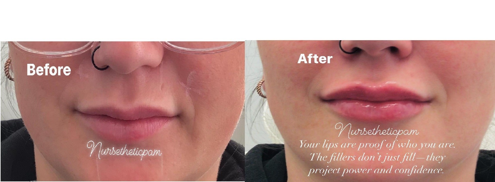 Lip Filler Before and After 