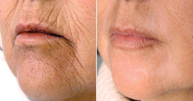 Erbium YAG Laser Resurfacing | Face & Neck