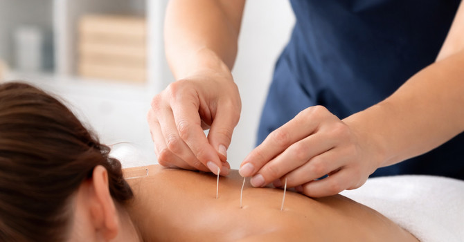 Acupuncture & Dry Needling