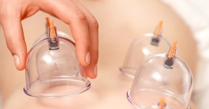 Cupping Therapy