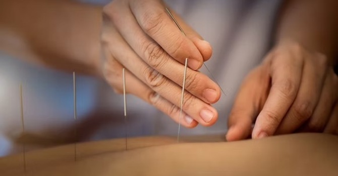 Acupuncture Under Physiotherapy Practice 