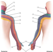 C5 dermatome diagram showing neck pain radiating into the shoulder and upper arm from the cervical spine.