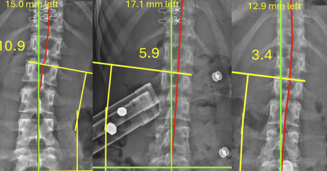 Reduction of Adolescent Idiopathic Scoliosis Utilizing the Labyrinthine Righting Reflex image