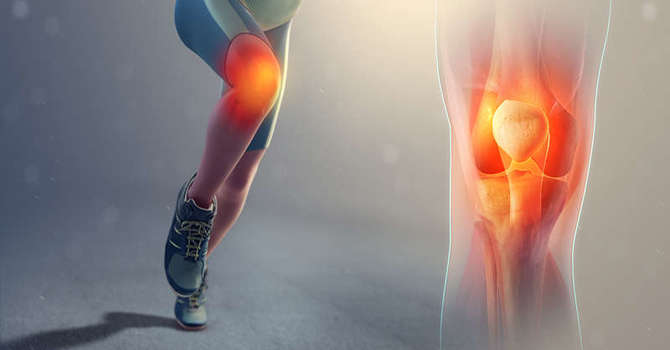 Patellofemoral Syndrome