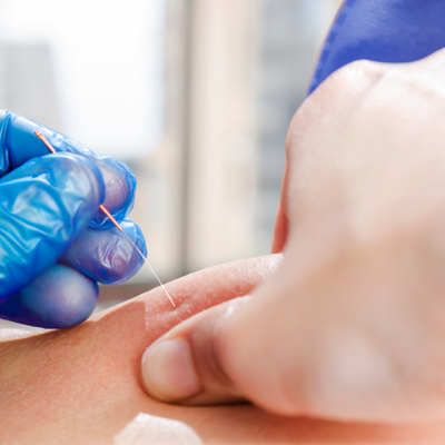 Link to: /treatments/dry-needling-treatments