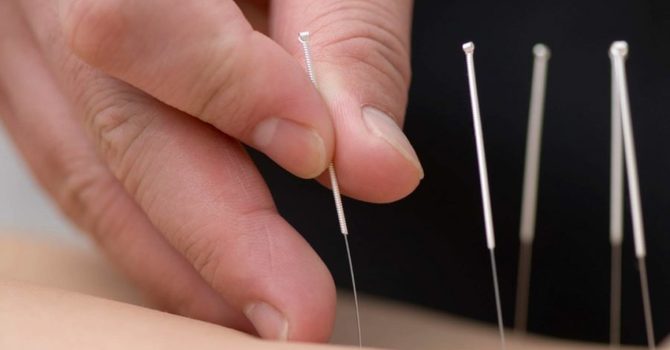 Dry Needling