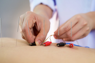 A person receiving electrostim acupuncture for vagus nerve treatment