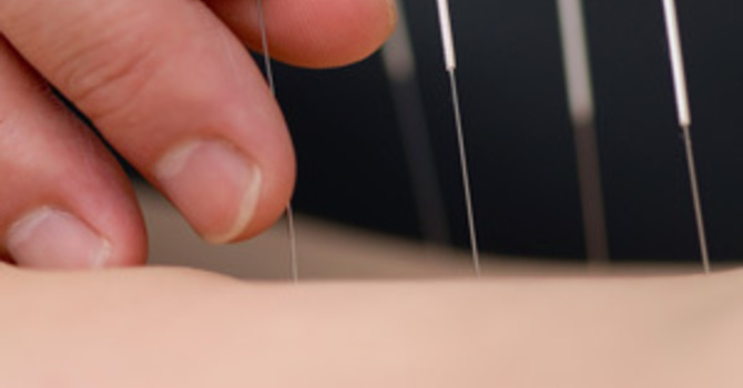 Acupuncture