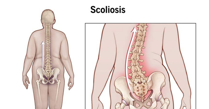 Adult Scoliosis and Curve Severity image