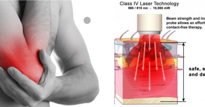 What Is a Class IV Laser and What Is It Used For? image