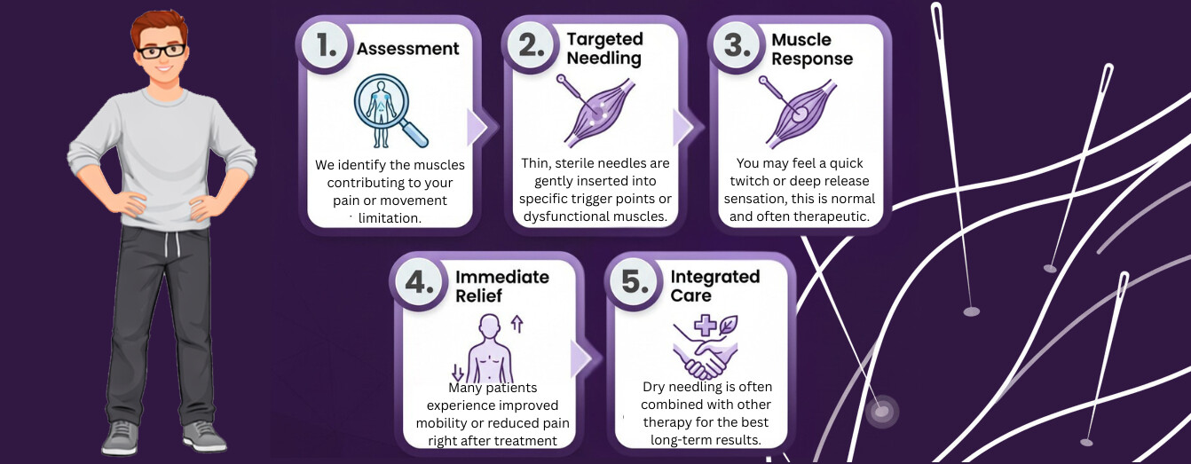Dry Needling: What to expect