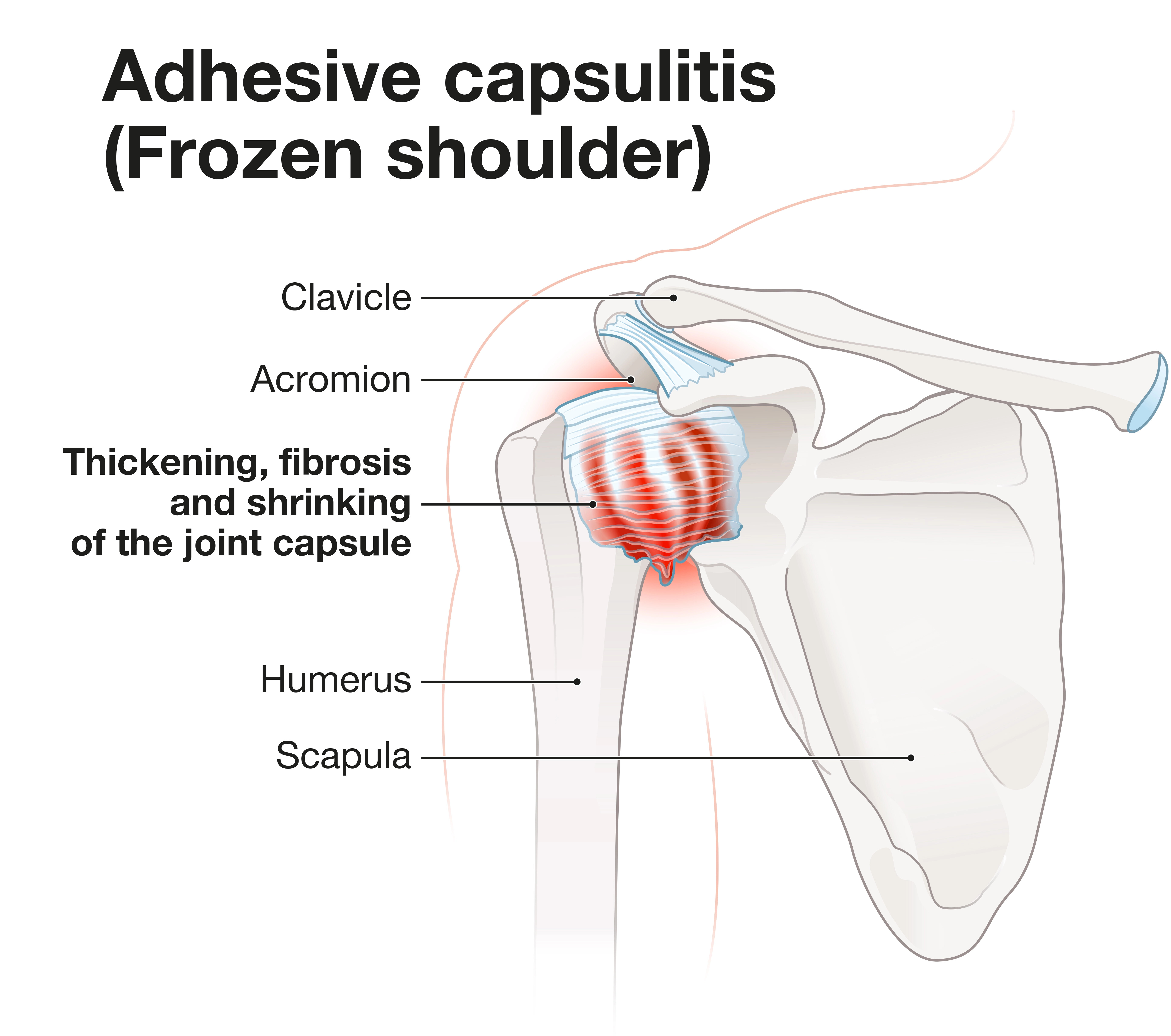 frozen shoulder