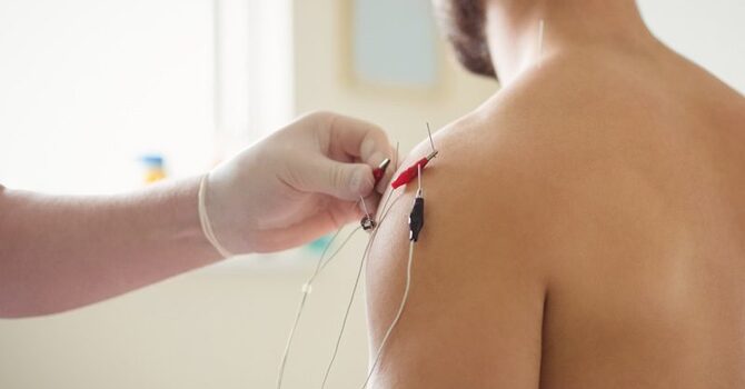 Dry Needling