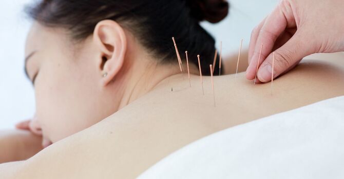 How Does Acupuncture for Stress Relief Support Calm and Balance? image