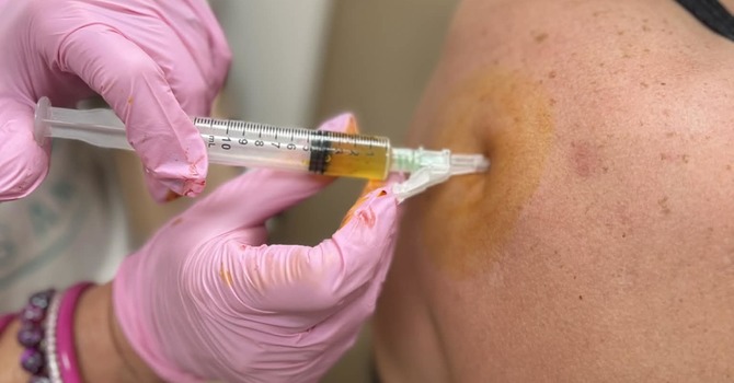 PRP Therapy for Pain: A Long-Term, Natural Alternative to Steroid Injections image