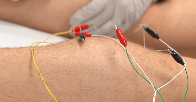 Modalities: Dry Needling