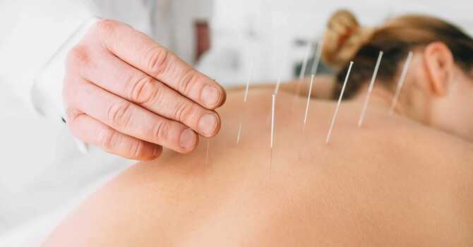Acupuncture