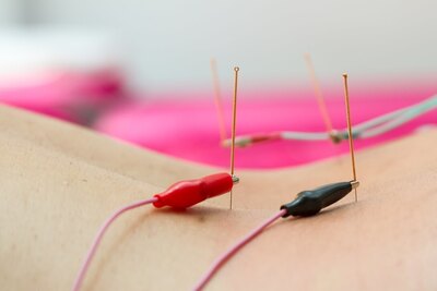 Link to: /pages/electro-acupuncture