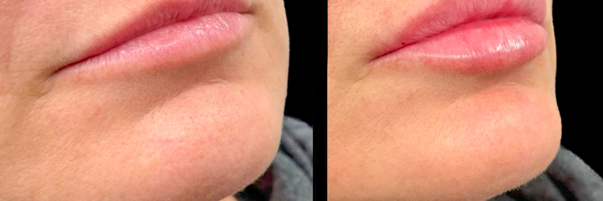 Aesthetic Unfiltered Aurora & Ocelli Aesthetics Terre Haute